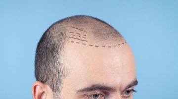 hair transplant