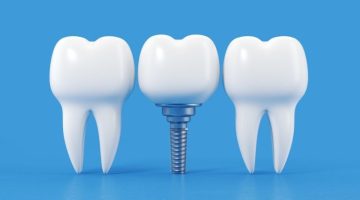dental implants