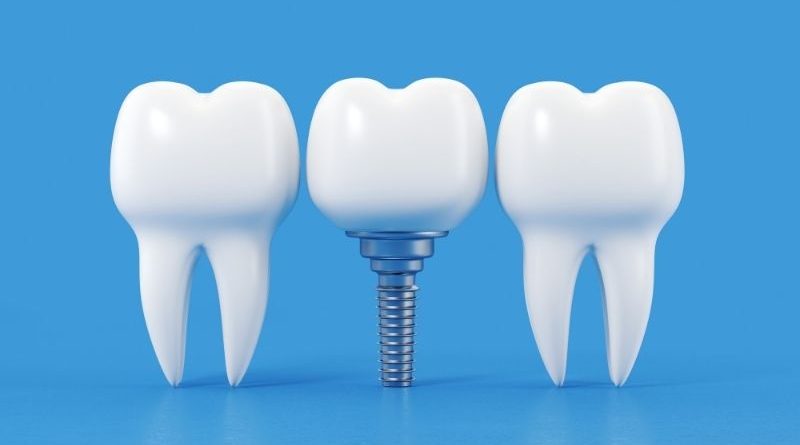 dental implants