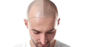 Who cannot have hair transplantation